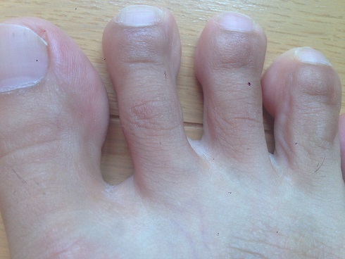 脱毛が終わったかと思っていた足の指毛がまた生えてきたの撮った画像