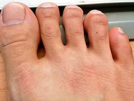 脱毛後の足の指毛の画像