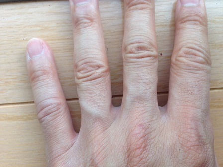 手の指の脱毛前の画像