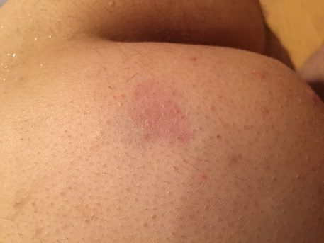 尻毛の脱毛で火傷した尻の画像